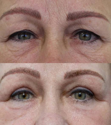 Crow’s Feet & Under Eye HIFU