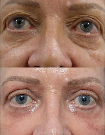 Eye Lift HIFU