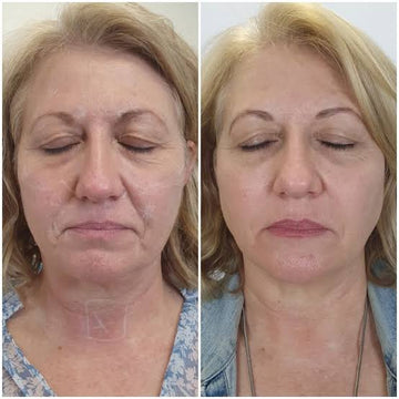 Full Face HIFU