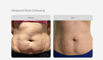 Body Contouring & RF - Abdomen