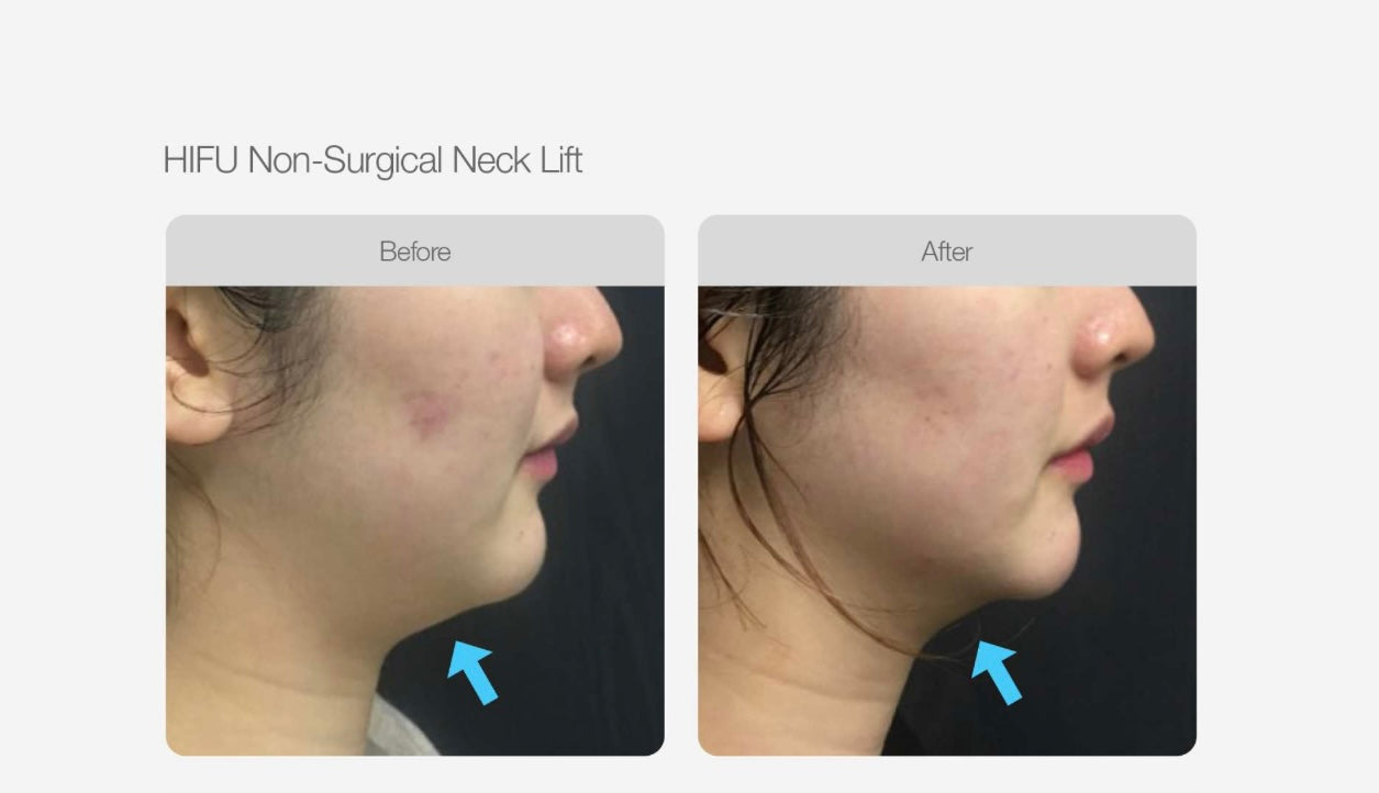 Full Face and Double Chin HIFU