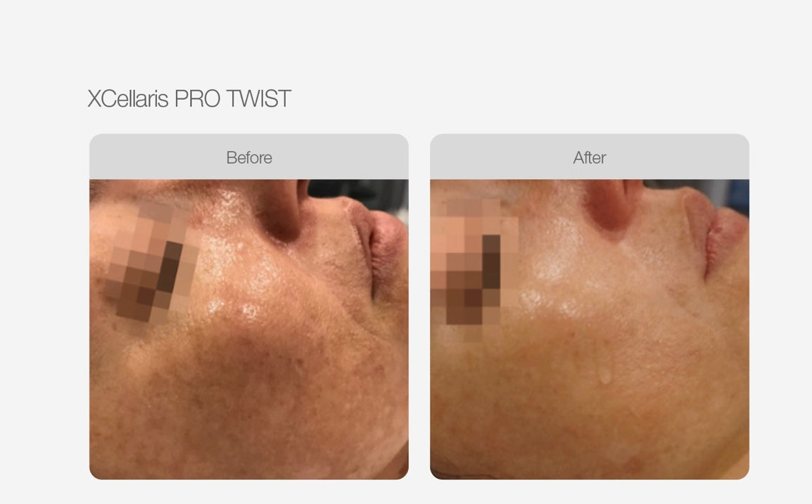 Micro Needling - Face & Neck