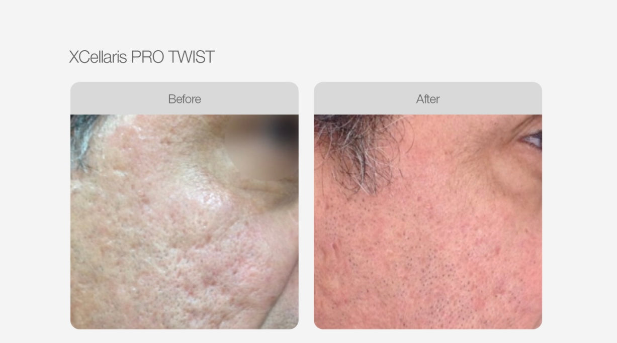 Micro Needling - Face, Neck & Décolletage