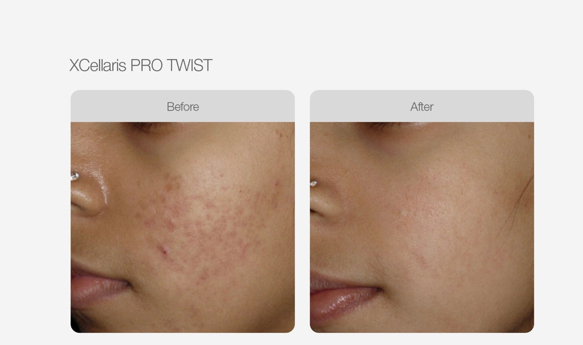 Micro Needling - Full Face