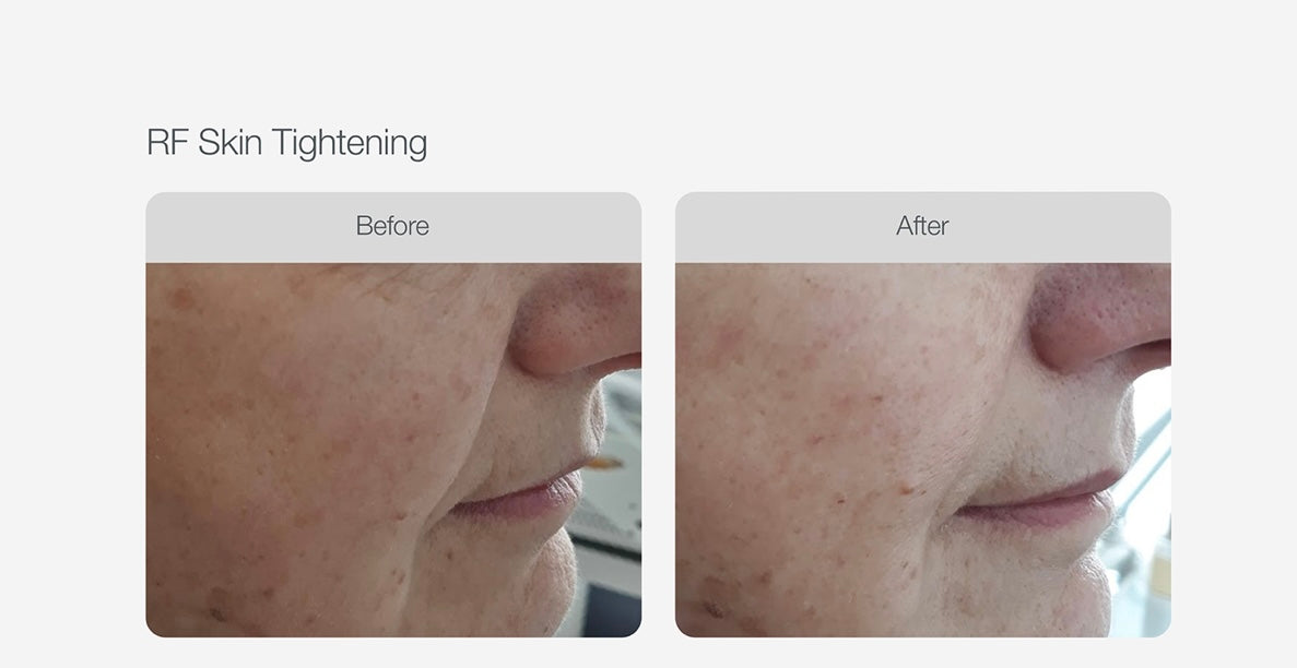 RF Skin Tightening - Face