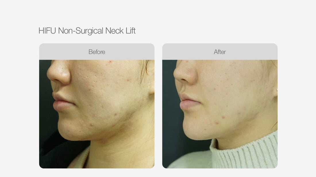 Full Face and Double Chin HIFU