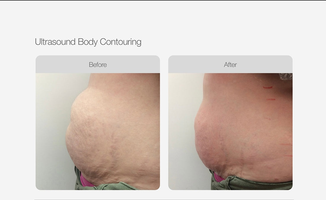 Body Contouring & RF - Abdomen